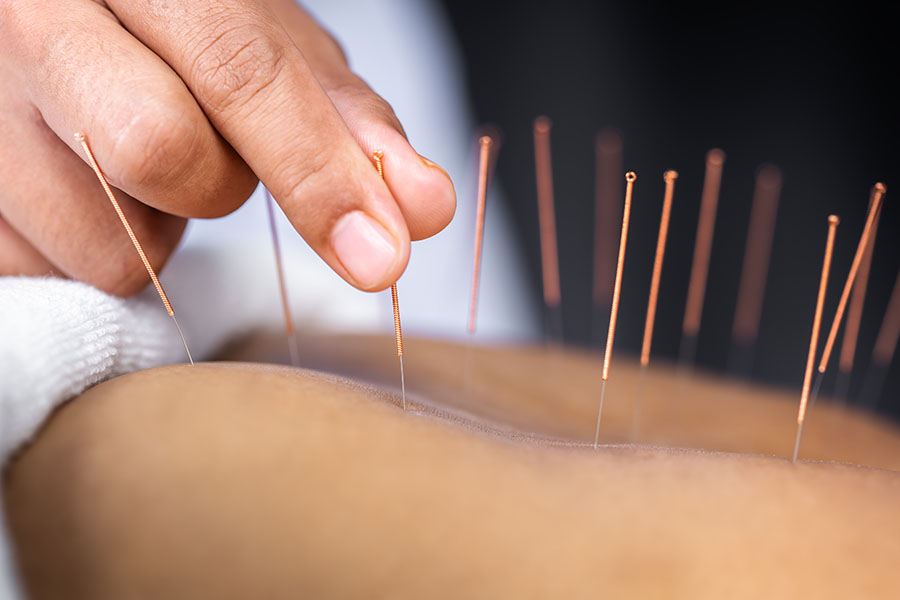 Acupuncture Featured as Cessation Tool